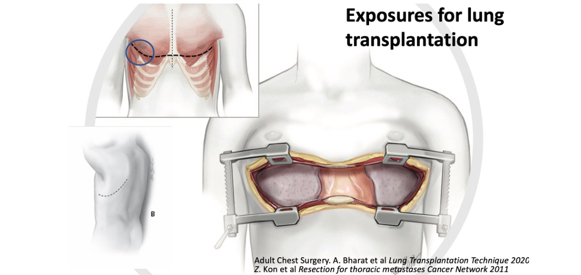 Lung Transplant Surgery Baylor Medicine